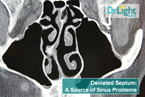 Deviated-Septum-A-Source-of-Sinus-Problems-300x200