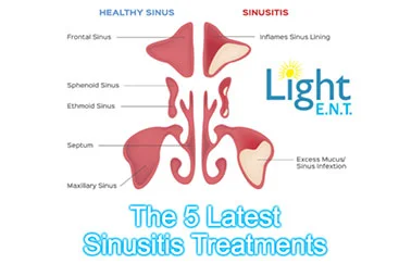 5-Latest-Sinusitis-Treatment