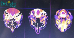 Sinus-Infections-300x157